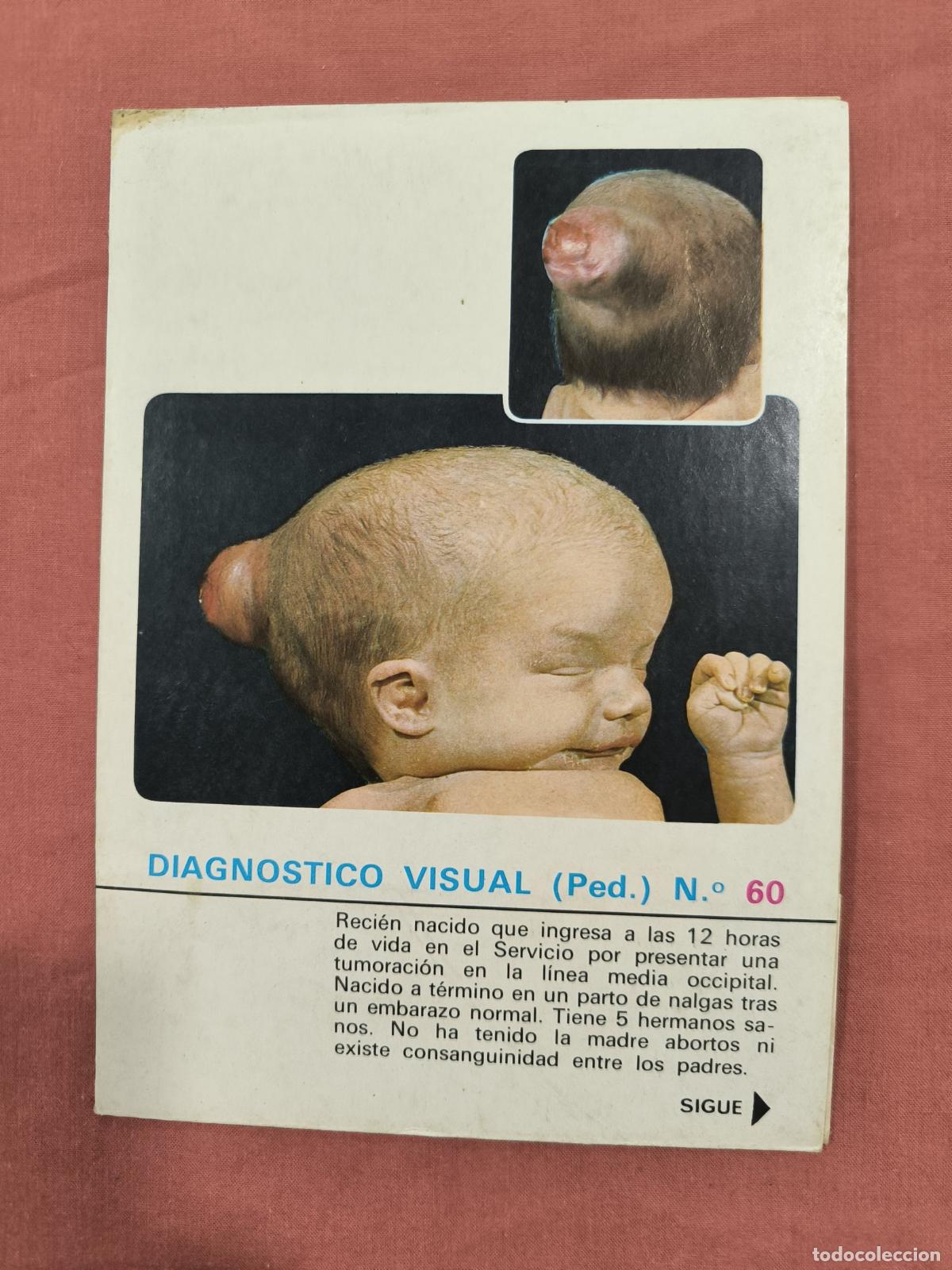 Sammeln von Zeitschriften und Zeitungen: L&aacute;mina Diagn&oacute;stico Visual Pediatr&iacute;a N&ordm; 60 Almirall &ndash; Caso Cl&iacute;nico Coleccionable