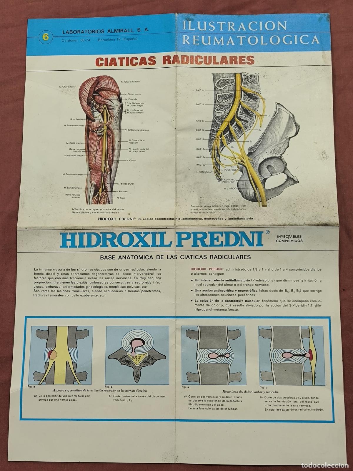 Collectionnisme de Revues et Journaux: L&aacute;mina M&eacute;dica Almirall Ilustraci&oacute;n Reumatol&oacute;gica Ci&aacute;ticas &ndash; Hidroxil Predni Coleccionismo