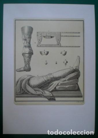 Colecionismo: MEDICINA: Sujecci&oacute;n de la rodilla (Grabador: Juan Barcel&oacute;n)