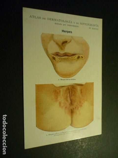 Collecting paper: TARJETA CROMOLITOGRAFICA ENFERMEDADES DE LA PIEL DERMATOLOGIA HACIA 1915 10 X 15 CM