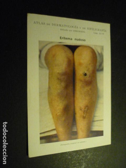 Sammelleidenschaft Papier: TARJETA CROMOLITOGRAFICA ENFERMEDADES DE LA PIEL DERMATOLOGIA HACIA 1915 10 X 15 CM