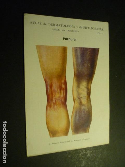 Sammelleidenschaft Papier: TARJETA CROMOLITOGRAFICA ENFERMEDADES DE LA PIEL DERMATOLOGIA HACIA 1915 10 X 15 CM