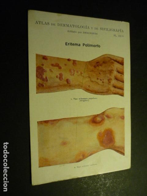 Sammelleidenschaft Papier: TARJETA CROMOLITOGRAFICA ENFERMEDADES DE LA PIEL DERMATOLOGIA HACIA 1915 10 X 15 CM