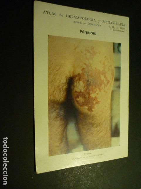Sammelleidenschaft Papier: TARJETA CROMOLITOGRAFICA ENFERMEDADES DE LA PIEL DERMATOLOGIA HACIA 1915 10 X 15 CM