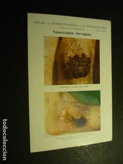 Sammelleidenschaft Papier: TARJETA CROMOLITOGRAFICA ENFERMEDADES DE LA PIEL DERMATOLOGIA HACIA 1915 10 X 15 CM