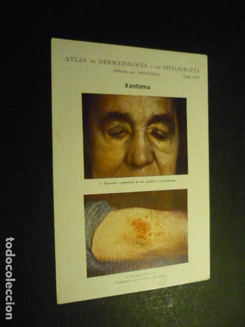 Sammelleidenschaft Papier: TARJETA CROMOLITOGRAFICA ENFERMEDADES DE LA PIEL DERMATOLOGIA HACIA 1915 10 X 15 CM