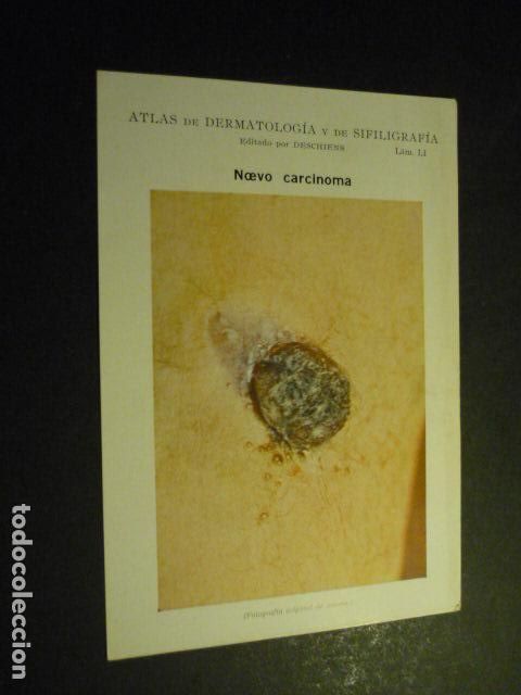 Sammelleidenschaft Papier: TARJETA CROMOLITOGRAFICA ENFERMEDADES DE LA PIEL DERMATOLOGIA HACIA 1915 10 X 15 CM