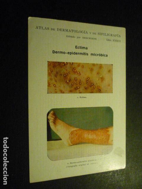 Sammelleidenschaft Papier: TARJETA CROMOLITOGRAFICA ENFERMEDADES DE LA PIEL DERMATOLOGIA HACIA 1915 10 X 15 CM