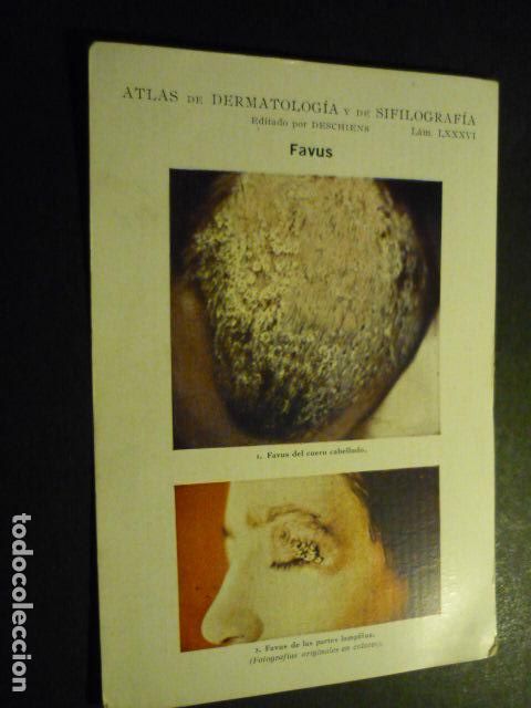 Sammelleidenschaft Papier: TARJETA CROMOLITOGRAFICA ENFERMEDADES DE LA PIEL DERMATOLOGIA HACIA 1915 10 X 15 CM