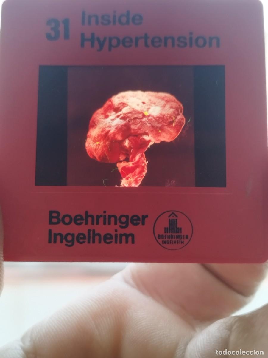 Fotograf&iacute;a antigua: Diapositiva &rdquo;Inside Hypertension&rdquo; (Dentro de la Hipertensi&oacute;n) la compa&ntilde;&iacute;a farmac&eacute;utica Boehringer.