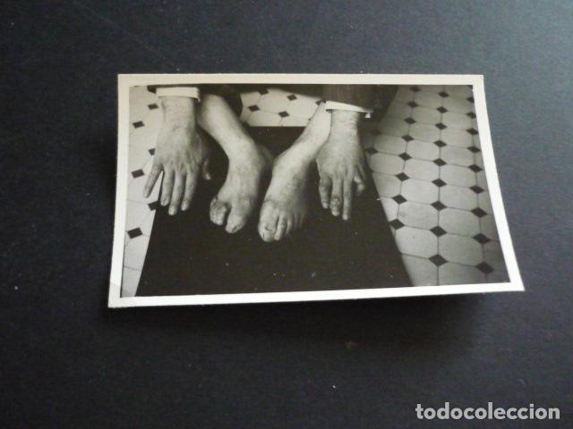 Fotograf&iacute;a antigua: FOTOGRAFIA MALFORMACION FISICA POR EL DOCTOR GARAIZABAL A&Ntilde;OS 40 ANTIGUA FOTOGRAFIA 6 X 9 CM