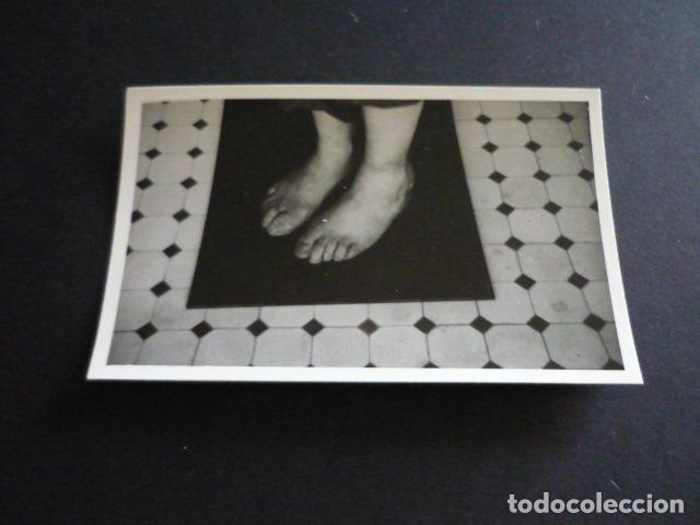 Fotograf&iacute;a antigua: FOTOGRAFIA MALFORMACION FISICA POR EL DOCTOR GARAIZABAL A&Ntilde;OS 40 ANTIGUA FOTOGRAFIA 6 X 9 CM