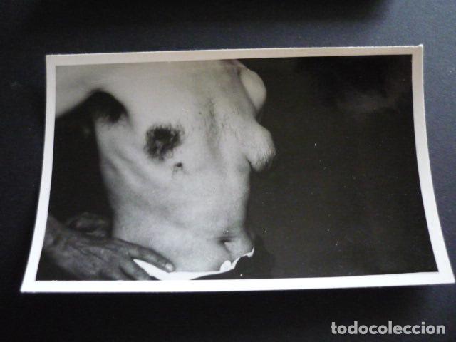 Fotograf&iacute;a antigua: FOTOGRAFIA MALFORMACION FISICA POR EL DOCTOR GARAIZABAL A&Ntilde;OS 40 ANTIGUA FOTOGRAFIA 6 X 9 CM