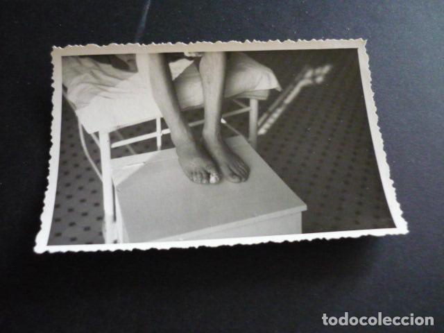 Alte Fotografie: FOTOGRAFIA MALFORMACION FISICA POR EL DOCTOR GARAIZABAL A&Ntilde;OS 40 ANTIGUA FOTOGRAFIA 6 X 9 CM