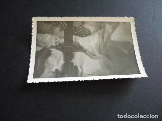 Alte Fotografie: FOTOGRAFIA MALFORMACION FISICA POR EL DOCTOR GARAIZABAL A&Ntilde;OS 40 ANTIGUA FOTOGRAFIA 6 X 9 CM