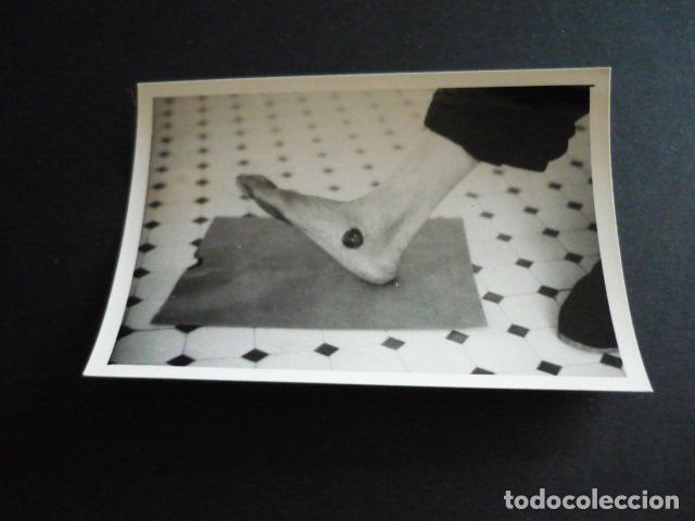 Alte Fotografie: FOTOGRAFIA MALFORMACION FISICA POR EL DOCTOR GARAIZABAL A&Ntilde;OS 40 ANTIGUA FOTOGRAFIA 6 X 9 CM