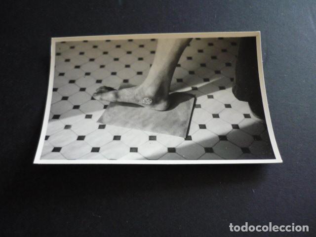 Fotograf&iacute;a antigua: FOTOGRAFIA MALFORMACION FISICA POR EL DOCTOR GARAIZABAL A&Ntilde;OS 40 ANTIGUA FOTOGRAFIA 6 X 9 CM