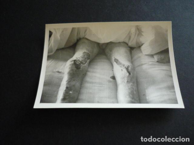 Alte Fotografie: FOTOGRAFIA MALFORMACION FISICA POR EL DOCTOR GARAIZABAL A&Ntilde;OS 40 ANTIGUA FOTOGRAFIA 6 X 9 CM