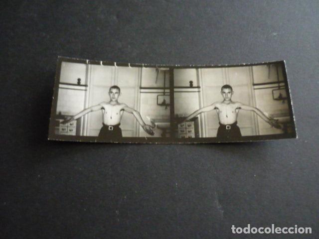 Alte Fotografie: FOTOGRAFIA MALFORMACION FISICA POR EL DOCTOR GARAIZABAL A&Ntilde;OS 40 ANTIGUA FOTOGRAFIA 3 X 7,5 CM