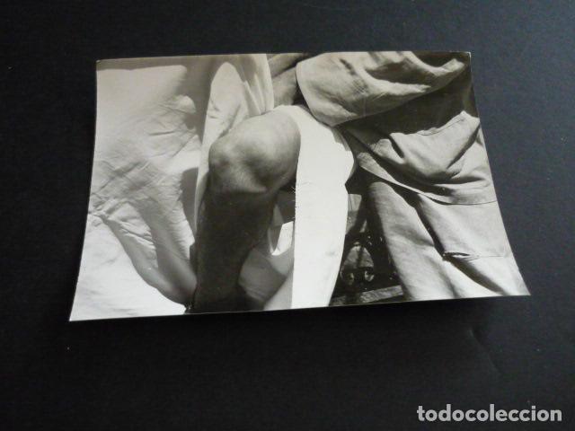 Alte Fotografie: FOTOGRAFIA MALFORMACION FISICA POR EL DOCTOR GARAIZABAL A&Ntilde;OS 40 ANTIGUA FOTOGRAFIA 7,5 X 10,5 CM