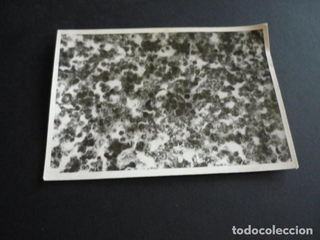 Alte Fotografie: FOTOGRAFIA MALFORMACION FISICA POR EL DOCTOR GARAIZABAL A&Ntilde;OS 40 ANTIGUA FOTOGRAFIA 7,5 X 10,5 CM