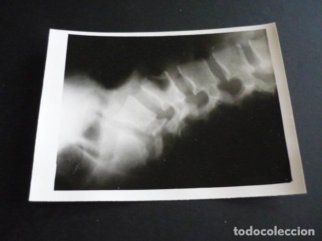 Alte Fotografie: FOTOGRAFIA MALFORMACION FISICA POR EL DOCTOR GARAIZABAL A&Ntilde;OS 40 ANTIGUA FOTOGRAFIA 7,5 X 10,5 CM