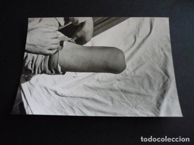 Alte Fotografie: FOTOGRAFIA MALFORMACION FISICA POR EL DOCTOR GARAIZABAL A&Ntilde;OS 40 ANTIGUA FOTOGRAFIA 7,5 X 10,5 CM
