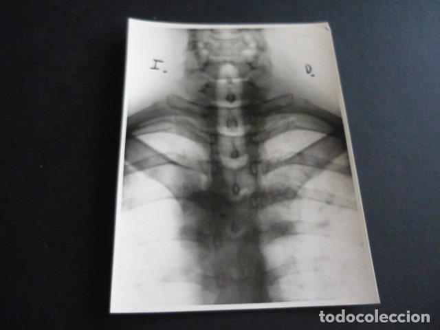 Alte Fotografie: FOTOGRAFIA MALFORMACION FISICA POR EL DOCTOR GARAIZABAL A&Ntilde;OS 40 ANTIGUA FOTOGRAFIA 7,5 X 10,5 CM
