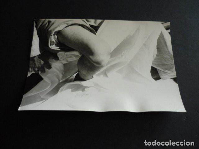 Fotograf&iacute;a antigua: FOTOGRAFIA MALFORMACION FISICA POR EL DOCTOR GARAIZABAL A&Ntilde;OS 40 ANTIGUA FOTOGRAFIA 7,5 X 10,5 CM