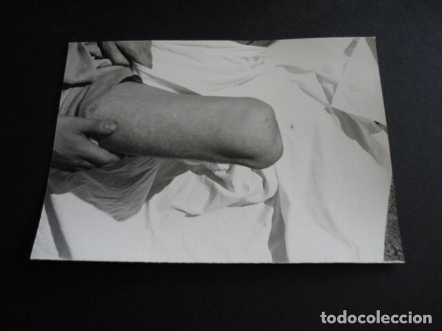 Alte Fotografie: FOTOGRAFIA MALFORMACION FISICA POR EL DOCTOR GARAIZABAL A&Ntilde;OS 40 ANTIGUA FOTOGRAFIA 7,5 X 10,5 CM