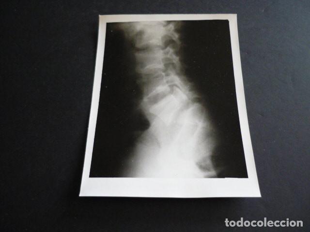 Fotograf&iacute;a antigua: FOTOGRAFIA MALFORMACION FISICA POR EL DOCTOR GARAIZABAL A&Ntilde;OS 40 ANTIGUA FOTOGRAFIA 7,5 X 10,5 CM