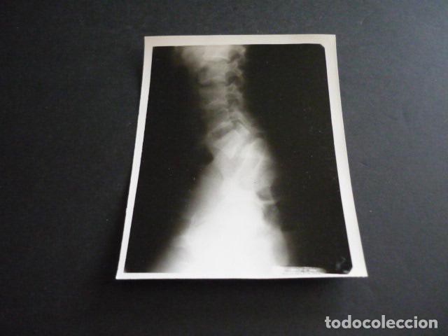 Alte Fotografie: FOTOGRAFIA MALFORMACION FISICA POR EL DOCTOR GARAIZABAL A&Ntilde;OS 40 ANTIGUA FOTOGRAFIA 7,5 X 10,5 CM