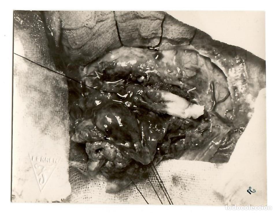 Photographie ancienne: Fotograf&iacute;a M&eacute;dica Cient&iacute;fica - SERVICIO INVESTIGADOR FERRER - Estudio Patolog&iacute;a - Rara