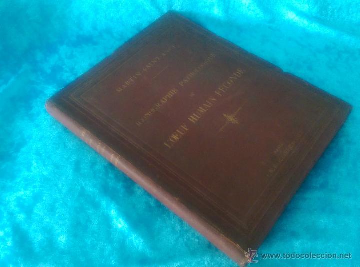 Antiquarische B&uuml;cher: ICONOGRAPHIE PATHOLOGIQUE DE L' OEUF HUMAIN FECONDE, G.J. MARTIN-SAINT-ANGE 1884