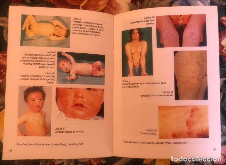Libros antiguos: MANUAL DE ALERGIA. UCB. 1992 - Foto 8