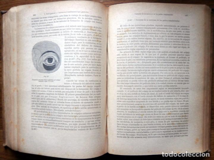 Libros antiguos: HUETER, C. DR. Elementos de Cirug&iacute;a. 2 Tomos. E.T.E.Teodoro 1885 - Foto 3