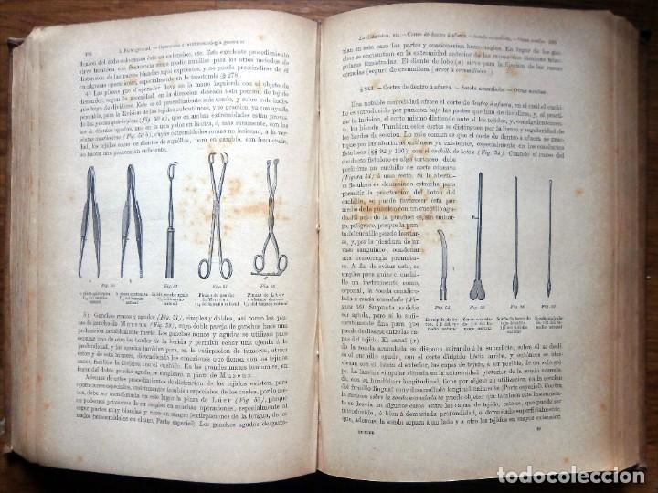 Libros antiguos: HUETER, C. DR. Elementos de Cirug&iacute;a. 2 Tomos. E.T.E.Teodoro 1885 - Foto 4