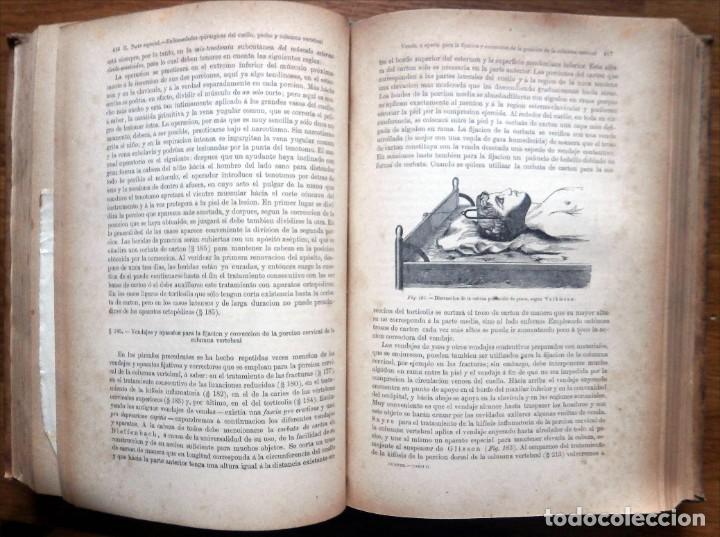 Libros antiguos: HUETER, C. DR. Elementos de Cirug&iacute;a. 2 Tomos. E.T.E.Teodoro 1885 - Foto 5