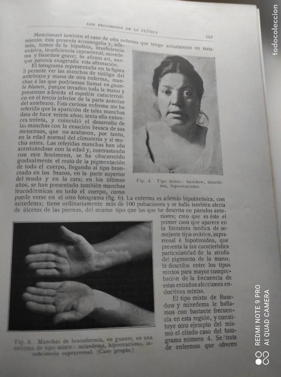 Libros antiguos: LOS PROGRESOS DE LA CL&Iacute;NICA A&Ntilde;O COMPLETO DE 1915 - Foto 10