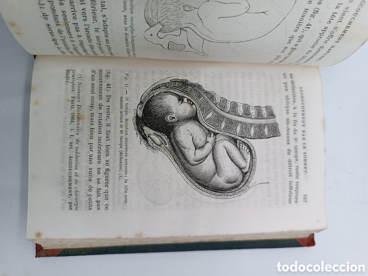 Libros antiguos: Guide practique de laccoucherur 1874 - Foto 5