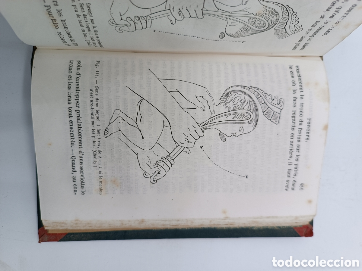 Libros antiguos: Guide practique de laccoucherur 1874 - Foto 6