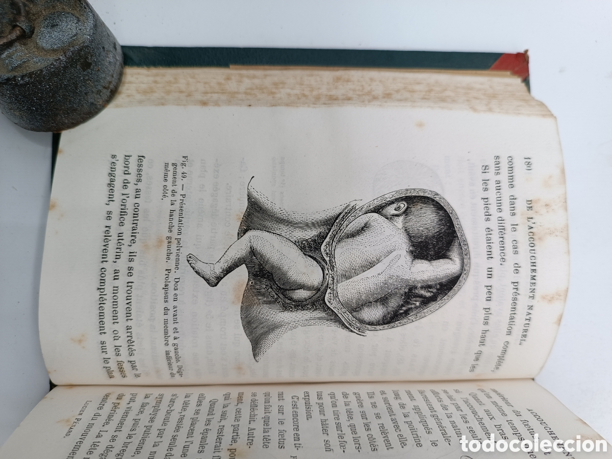 Libros antiguos: Guide practique de laccoucherur 1874 - Foto 9