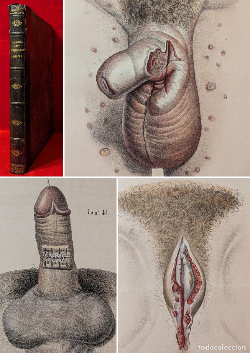 Libros antiguos: ❤️️A&Ntilde;O 1861 - TRATADO COMPLETO DE LAS ENFERMEDADES VEN&Eacute;REAS - 50 L&Aacute;MINAS COLOREADAS - GRABADOS