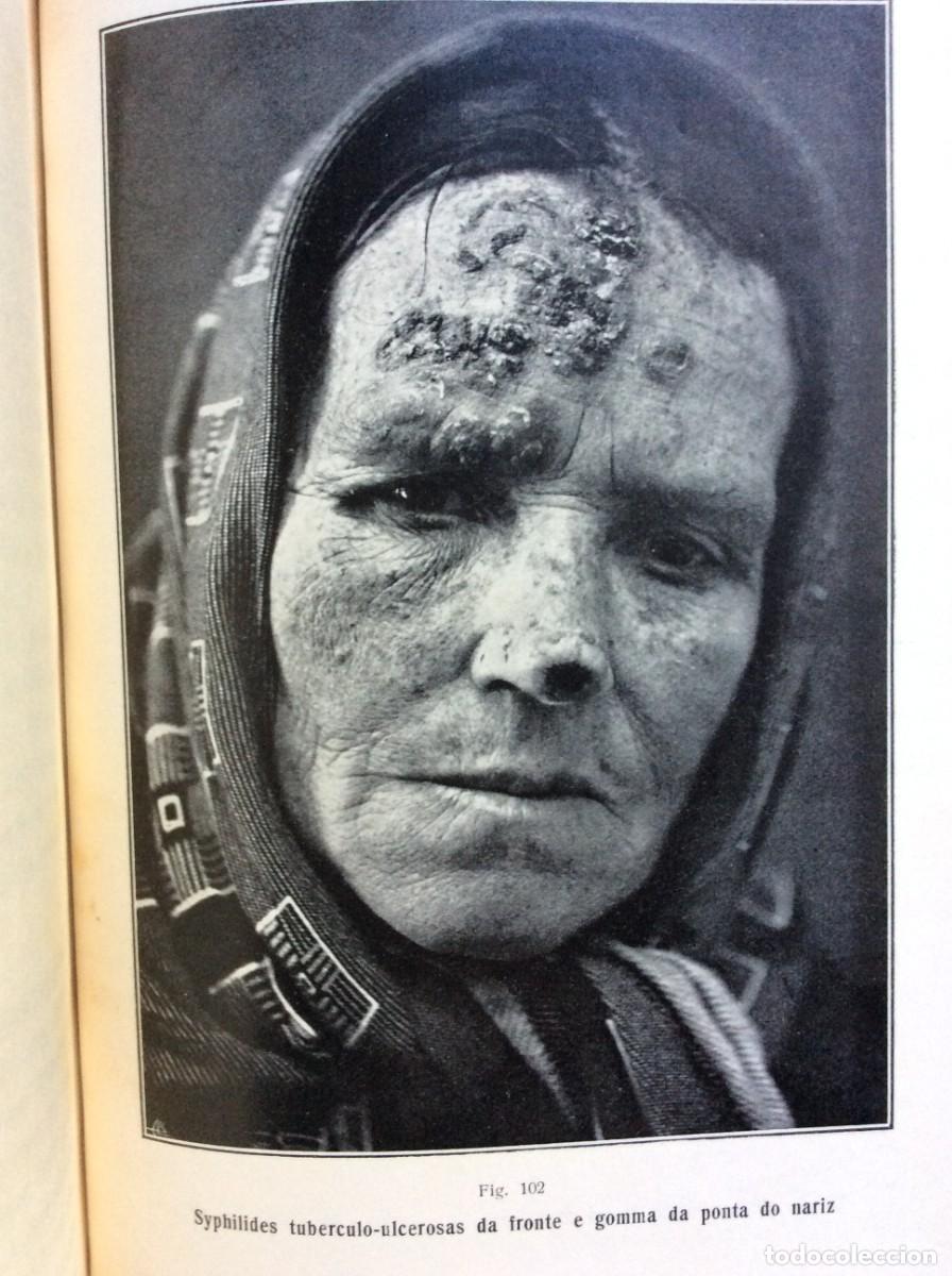 Libros antiguos: (Dr. Luiz de Freitas Viegas) - a syphilis - suas manifesta&ccedil;&otilde;es tegumentares. Imagens impressionantes