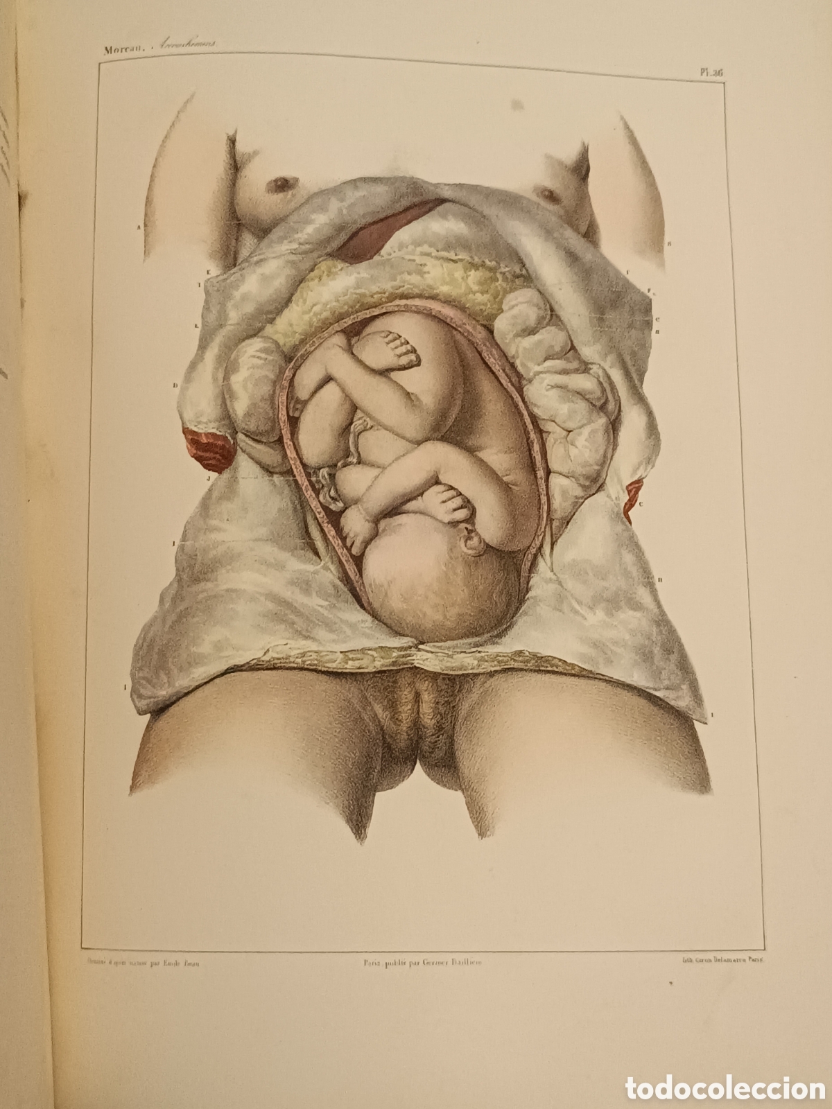 Old books: MOREAU- TRAITE PRATIQUE DES ACCOUCHEMENTS 1&ordf; edic&oacute;n 1837- ATLAS DEL PARTO 60 LITOGRAF&Iacute;AS COLOR