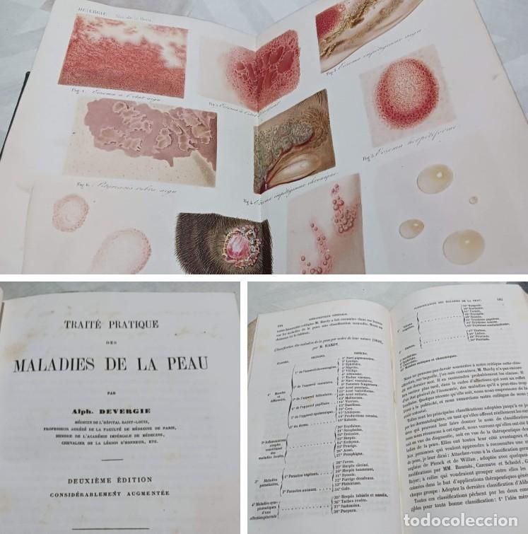 Old books: A&Ntilde;O 1857: ENFERMEDADES DE LA PIEL (MALADIES DE LA PEAU) - ILUSTRADO CON L&Aacute;MINAS