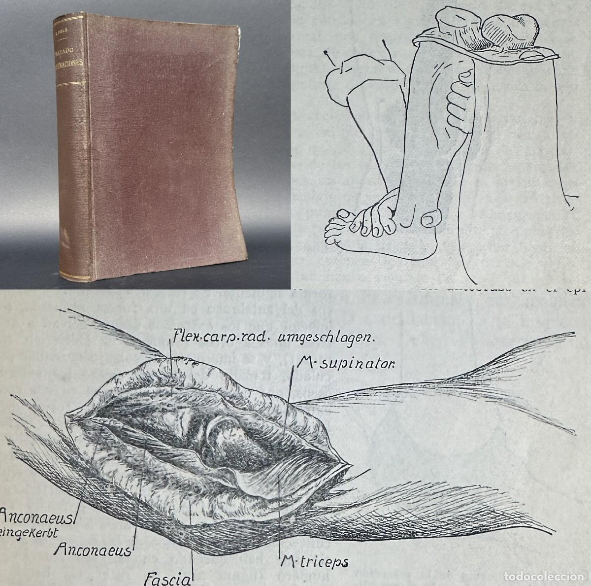 Antiquarische B&uuml;cher: A&Ntilde;O 1923 - TRATADO DE OPERACIONES - 778 ILUSTRACIONES - MEDICINA OPERATORIA - Cirugia
