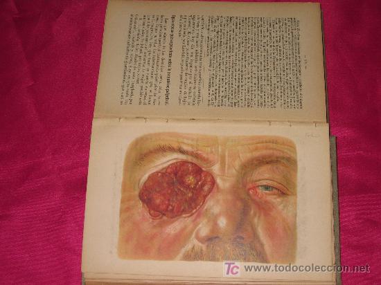 Libros antiguos: ATLAS MANUAL DE LAS OPERACIONES OFTALMOL&Oacute;GICAS - Foto 3