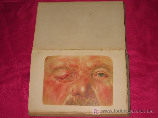 Libros antiguos: ATLAS MANUAL DE LAS OPERACIONES OFTALMOL&Oacute;GICAS - Foto 4