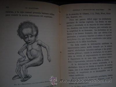 Libros antiguos: 1895 EL RAQUITISMO J. COMBY MUY RARO - Foto 2